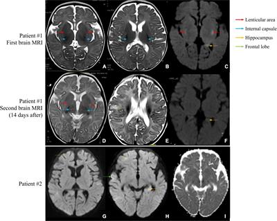 Clinical and genetic analyses of premature mitochondrial encephalopathy with epilepsia partialis continua caused by novel biallelic NARS2 mutations